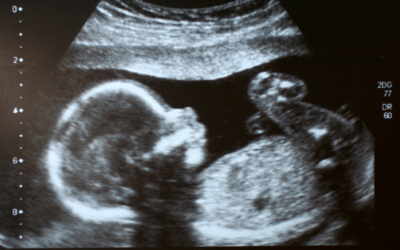 What is Abortion?