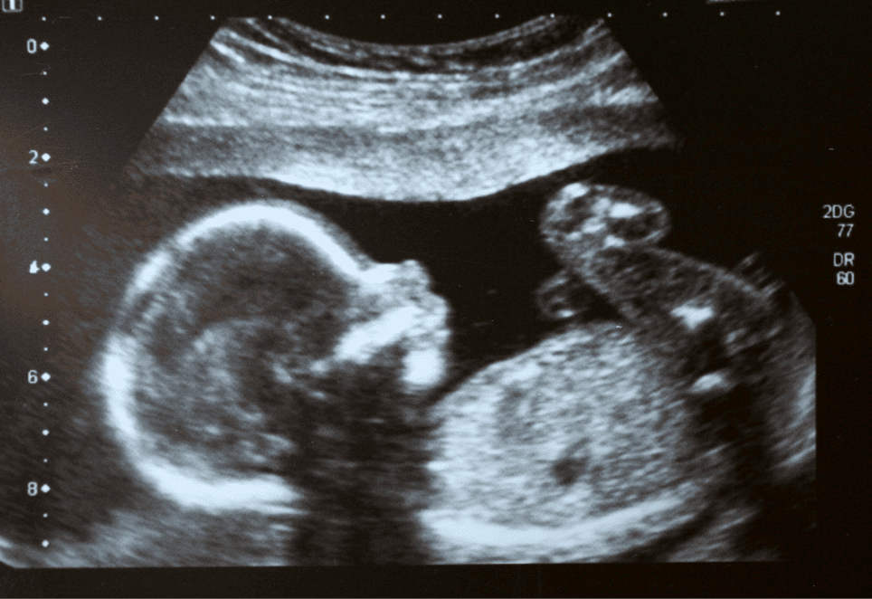 GRTL ultrasound baby in the womb2